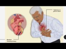 Embedded thumbnail for Preventing Cardiovascular Diseases, SPICES DST PROJECT